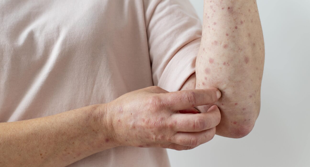Chikenpox Parent Pulse Article Featured Image