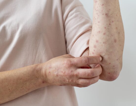 Chikenpox Parent Pulse Article Featured Image