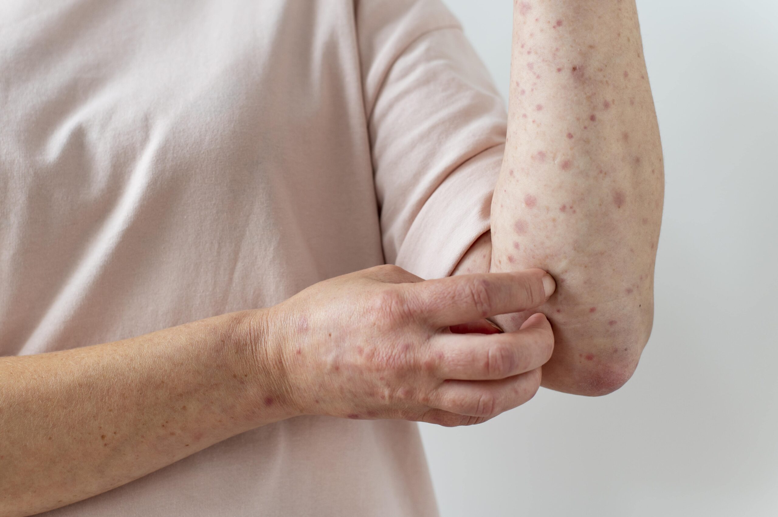 Chikenpox Parent Pulse Article Featured Image