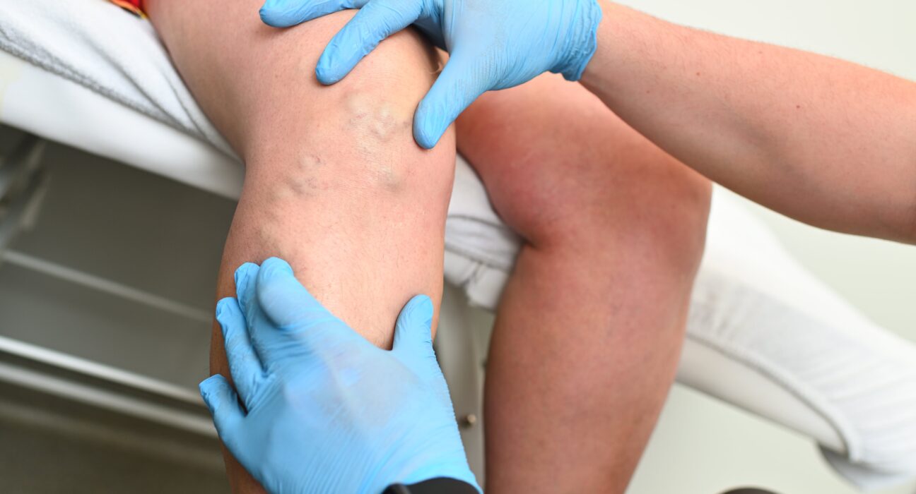 Varicose Parent Pulse Article Featured Image